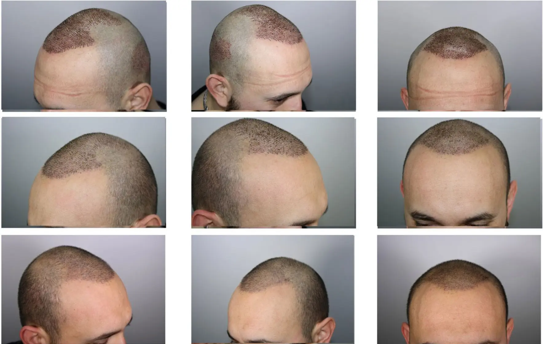 Recipient scalp area from different angles before hair implant