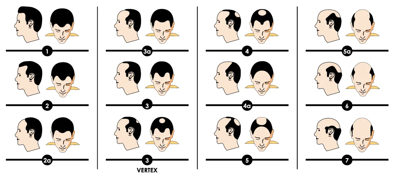 Norwood hair loss scale