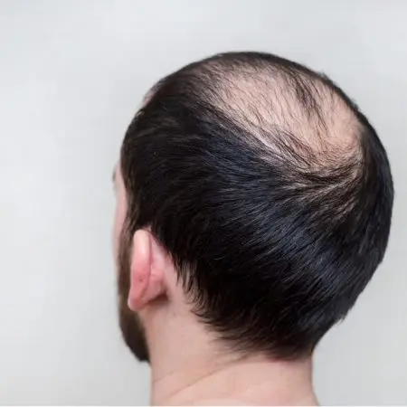 Minoxidil results and application
