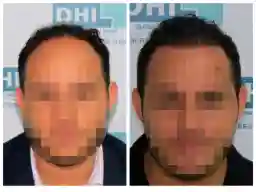 Patient 3 before and after hair transplant Panama