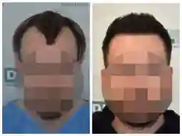 Patient 1 before and after hair transplant Panama