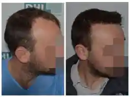 Patient 4 before and after hair transplant Panama