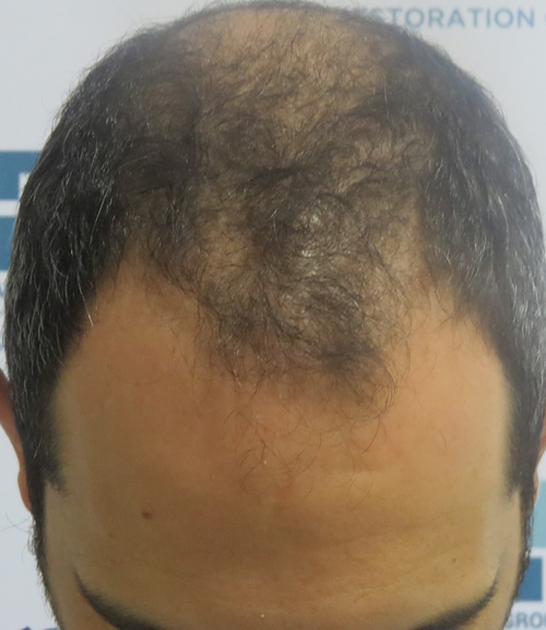 Patient with male pattern baldness before hair transplant procedure in Panama