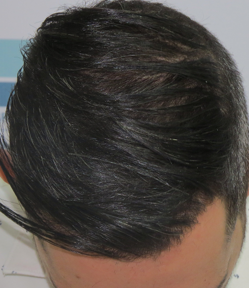 Patient showing hair restoration results after DHI hair transplant procedure in Panama